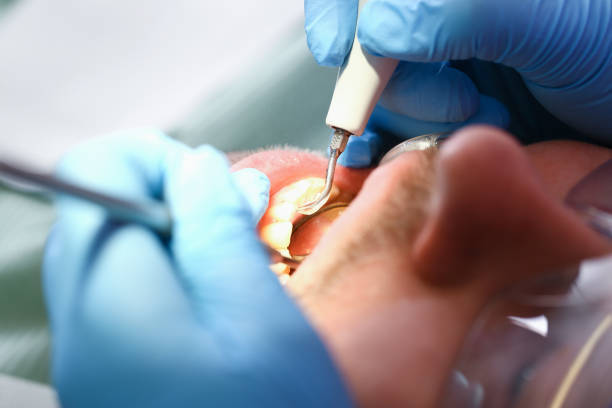 Best Emergency Dental Care for Abscessed Tooth in Buckhead Ridge, FL
